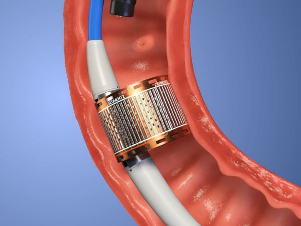 Endogenex ReCET Procedure for Type 2 Diabetes