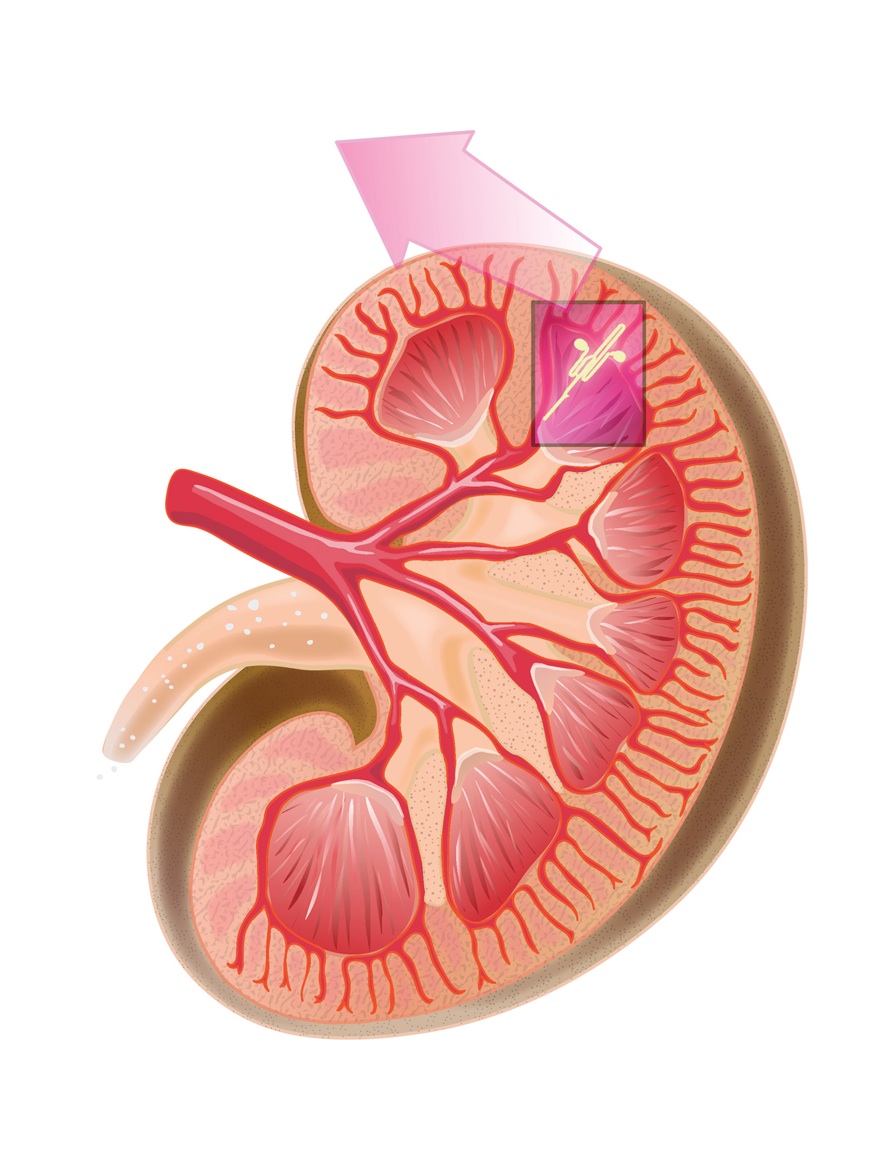 Kidney Nephropathy CREDENCE Invokana