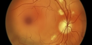 Eye scan showing diabetic retinopathy