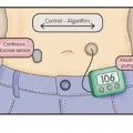 Artificial Pancreas trial