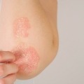 Psoriasis on elbow